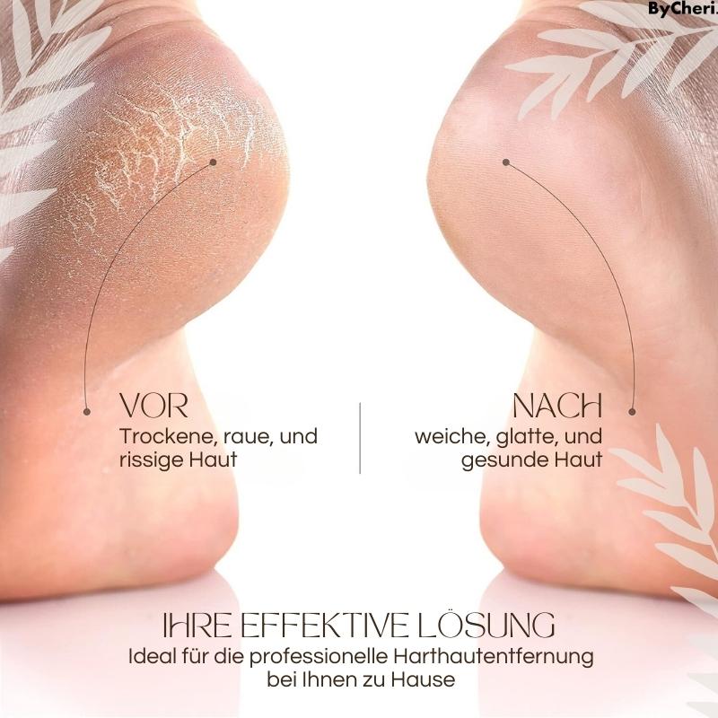 50% Rabatt temporär | CallusMaster™ - Elektrischer Hornhautzauberer