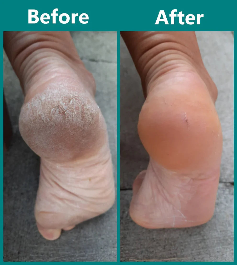 SoftTouch Foot Renewers — Silky Smooth Steps Instantly