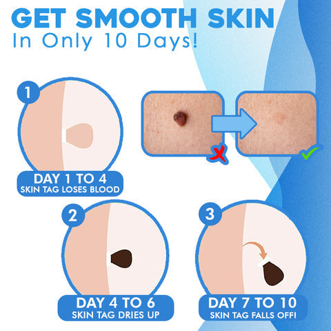 FlawFix™ Skin Tag Removal Kit